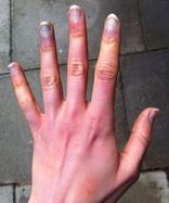 Raynaud's disease, cold hands and feet